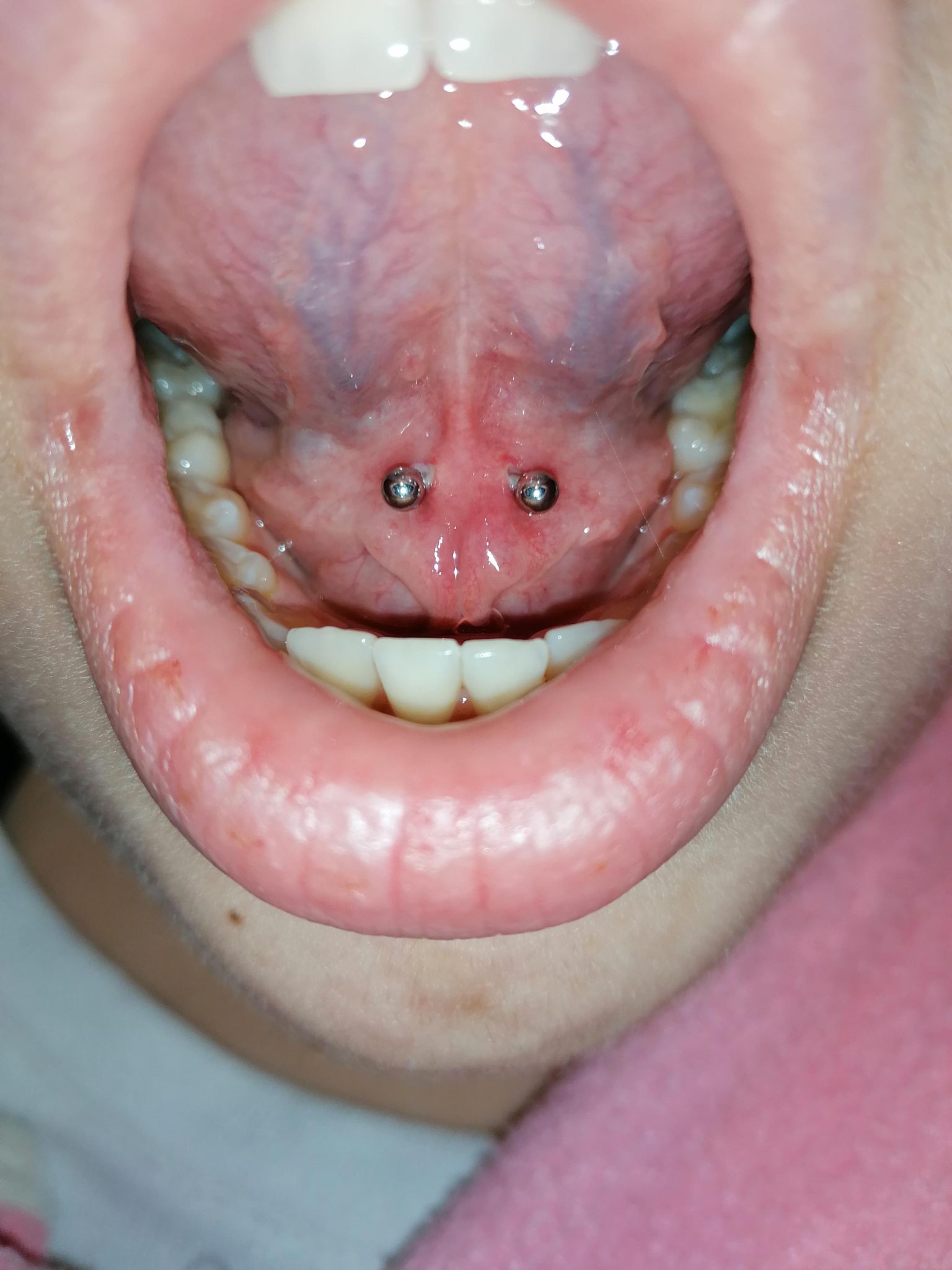 Tongue Web (Frenulum) Piercing